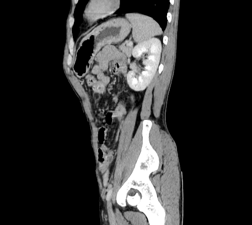 File:Bronchiectasis in Crohn disease (Radiopaedia 60311-67977 D 86).jpg