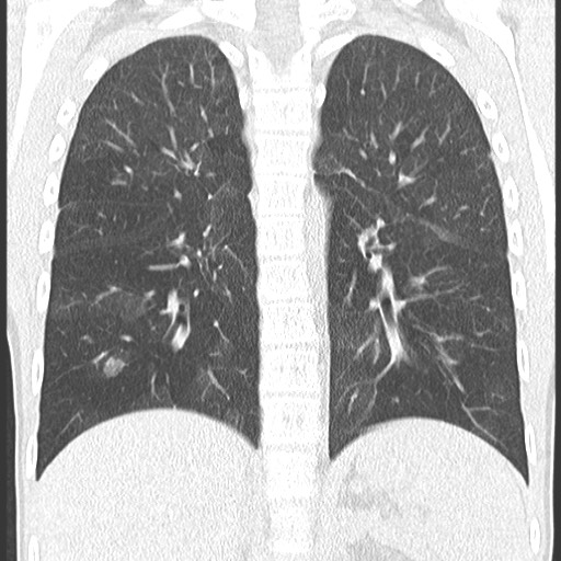 File:Bronchiolotis obliterans (Radiopaedia 73769-84575 Coronal lung window 25).jpg