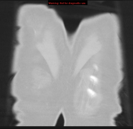 Bronchoalveolar carcinoma (BAC) (Radiopaedia 13436-13392 Coronal lung window 60).jpg