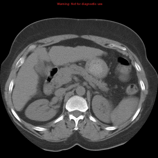Bronchoalveolar carcinoma (Radiopaedia 13224-13233 Axial non-contrast 53).jpg