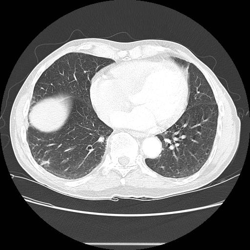 Bronchocele (Radiopaedia 17097-16795 Axial lung window 81).jpg