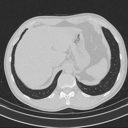 File:Bronchocele (Radiopaedia 60676-68429 Axial lung window 67).jpg