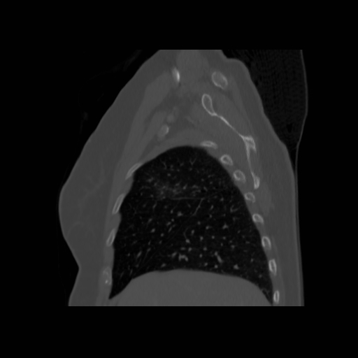 Bronchogenic carcinoma (Radiopaedia 73497-84262 Sagittal bone window 40).jpg