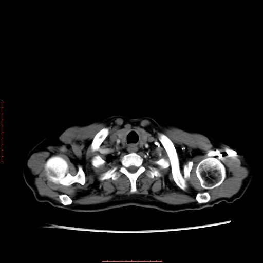File:Bronchogenic carcinoma with left atrial large deposit - T4N3M1a (Radiopaedia 42316-45428 A 4).jpg