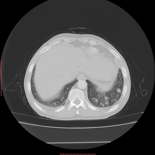 File:Bronchogenic carcinoma with left atrial large deposit - T4N3M1a (Radiopaedia 42316-45428 Axial lung window 25).jpg