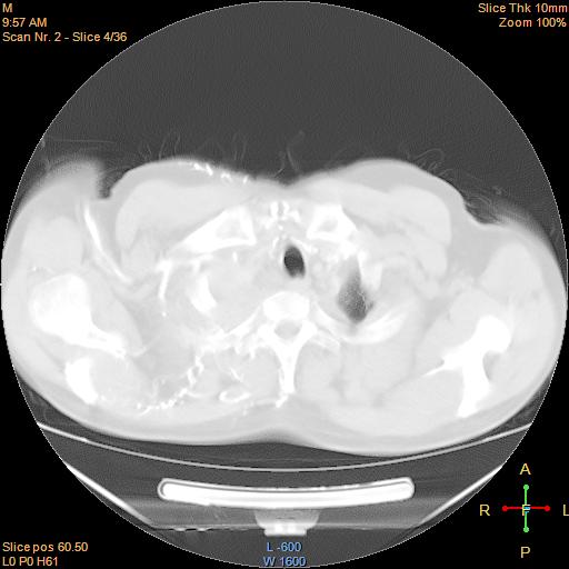 File:Bronchogenic carcinoma with superior vena caval invasion (Radiopaedia 22378-22406 lung window 1).jpg