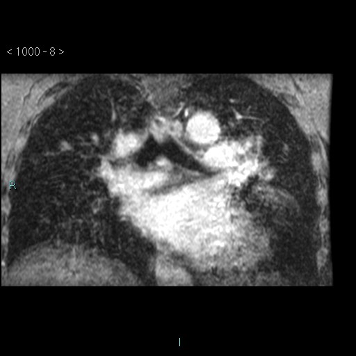 File:Bronchogenic cyst - posterior mediastinal (Radiopaedia 43885-47365 Coronal T1 C+ 7).jpg