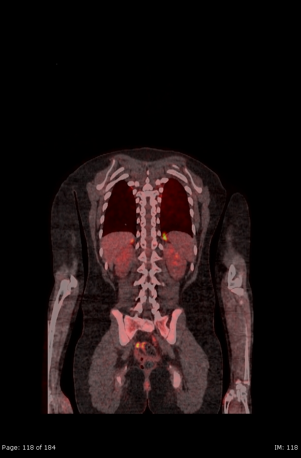 Brown fat uptake (FDG PET-CT) (Radiopaedia 77392-89513 Fused coronal 76).jpg