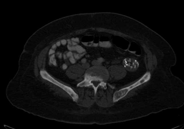 Brown tumors compressing the spinal cord (Radiopaedia 68442-77988 G 84).jpg