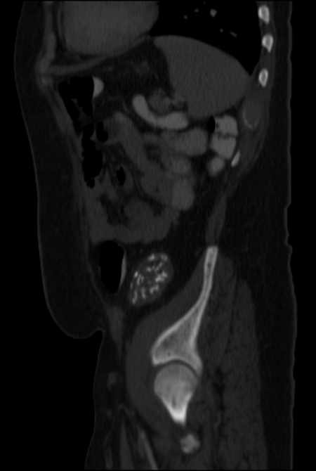 Brown tumors compressing the spinal cord (Radiopaedia 68442-77988 H 43).jpg