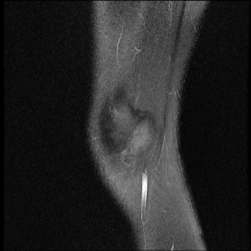 File:Bucket handle tear - lateral meniscus (Radiopaedia 72124-82634 Sagittal PD fat sat 16).jpg