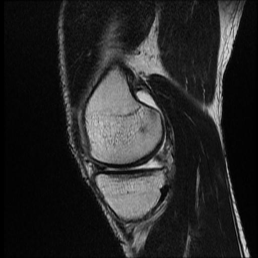 File:Bucket handle tear - medial meniscus (Radiopaedia 69245-79026 Sagittal T2 15).jpg