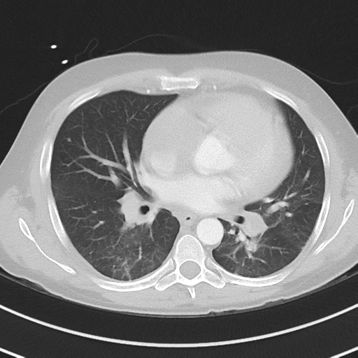 File:Burkitt lymphoma (Radiopaedia 34686-36121 Axial lung window 27).png