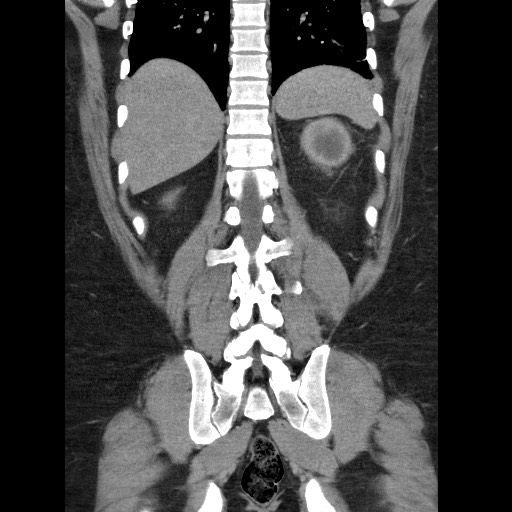 Burned-out testicular seminoma - retroperitoneal nodal metastases (Radiopaedia 62872-71245 B 51).jpg