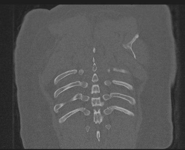Burst fracture - thoracic spine (Radiopaedia 30238-30865 Coronal bone window 145).jpg