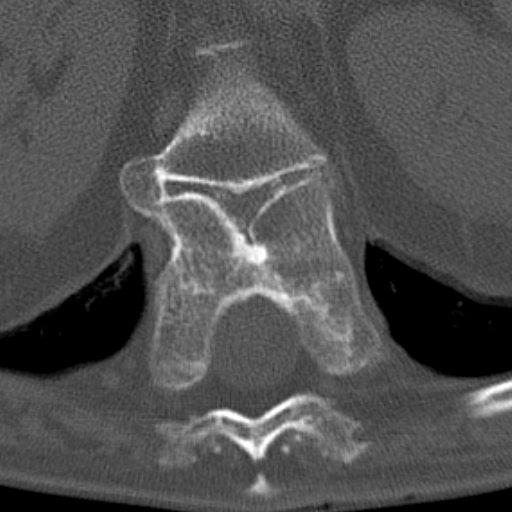 Butterfly vertebrae with kyphoscoliosis (Radiopaedia 14257-14133 Axial bone window 52).jpg