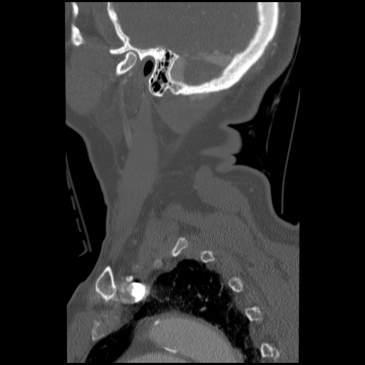 File:C1 anterior arch (plough) fracture - type 1 (Radiopaedia 76181-87720 Sagittal bone window 19).jpg