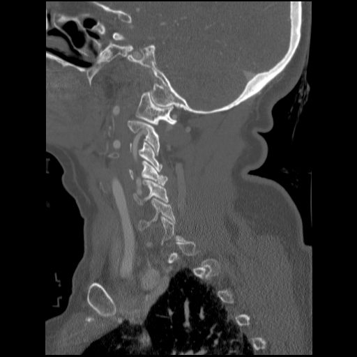 File:C1 anterior arch (plough) fracture - type 1 (Radiopaedia 76181-87720 Sagittal bone window 75).jpg