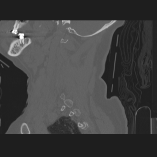 C2 fracture (Radiopaedia 34091-35341 Sagittal bone window 58).png