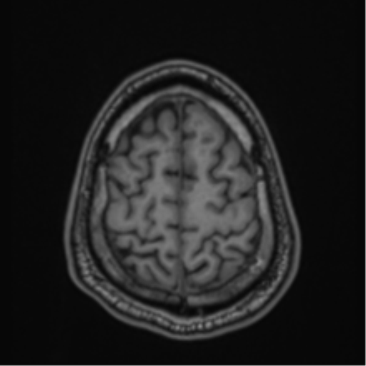 CNS vasculitis (Radiopaedia 55715-62263 Axial T1 86).png