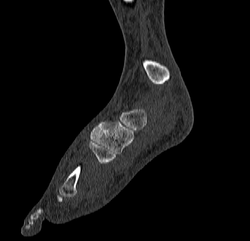 File:Calcaneal fracture - Sanders type 4 (Radiopaedia 90179-107370 Sagittal bone window 31).jpg
