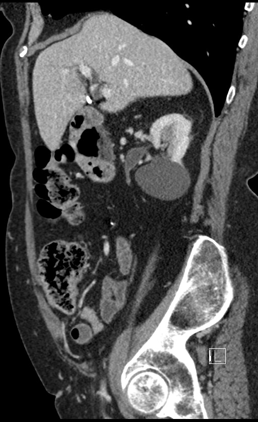Calcified adrenal glands and Spigelian hernia (Radiopaedia 49741-54988 C 111).jpg