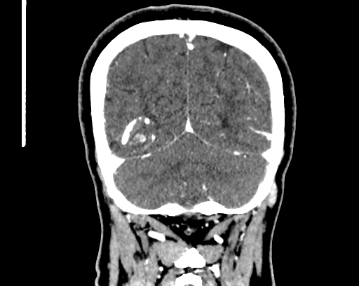 File:Calcified cerebral hydatid cyst (Radiopaedia 65603-74717 C 60).jpg