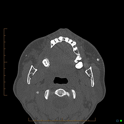 Calcified facial augmentation fillers (Radiopaedia 79514-92679 Axial bone window 86).jpg