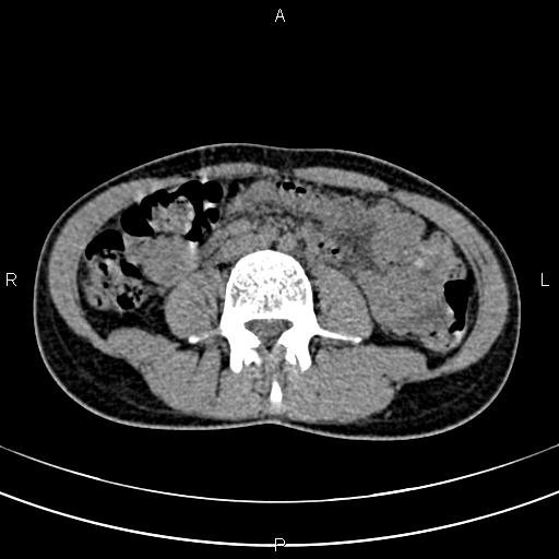 File:Calcified hepatic hydatid cyst (Radiopaedia 83870-99072 Axial non-contrast 100).jpg
