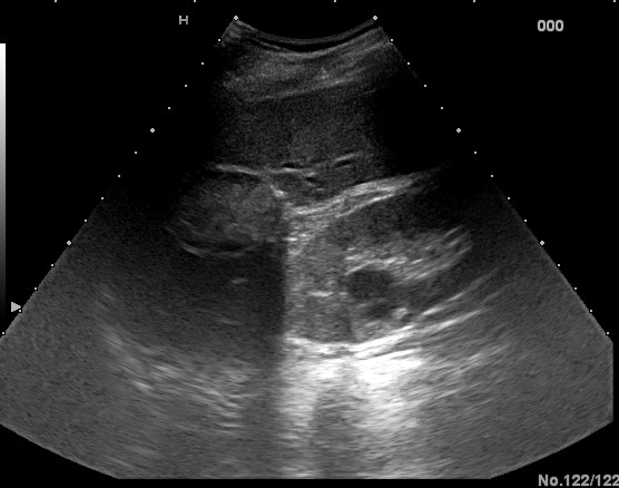 File:Calcified hydatid liver cyst (Radiopaedia 56633).jpg