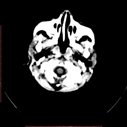 File:Calcified middle cerebral artery embolism (Radiopaedia 78949-91860 Axial non-contrast 2).jpg