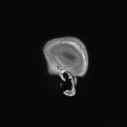 Callosal dysgenesis with interhemispheric cyst (Radiopaedia 53355-59335 Sagittal T1 169).jpg