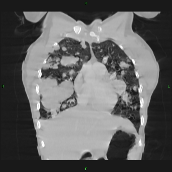 File:Cannon ball metastases - synovial sarcoma (Radiopaedia 26135-26271 Coronal lung window 3).jpg