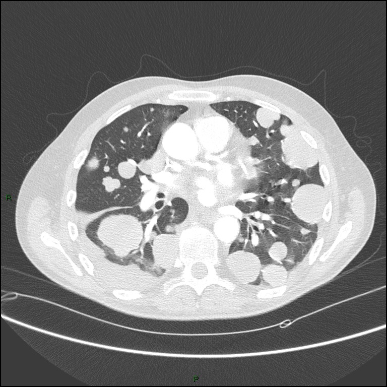 Cannonball metastases (Radiopaedia 82110-96150 Axial lung window 105).jpg