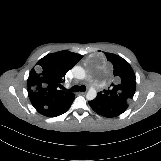 Cannonball metastases - testicular choriocarcinoma (Radiopaedia 84510-99891 B 48).jpg