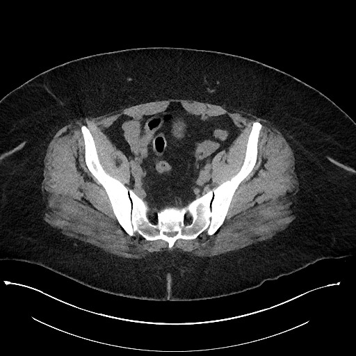 Carcinoid tumor - terminal ileum (Radiopaedia 60931-68740 Axial non-contrast 96).jpg