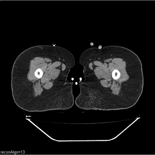 Carcinoma cervix- brachytherapy applicator (Radiopaedia 33135-34173 Axial non-contrast 69).jpg