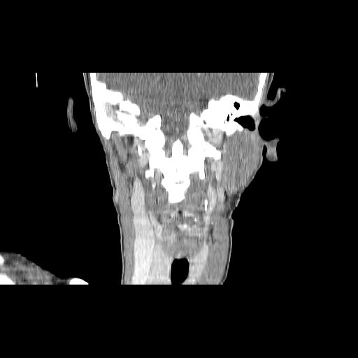 File:Carcinoma of the maxillary antrum (Radiopaedia 53805-59888 Coronal C+ delayed 105).jpg