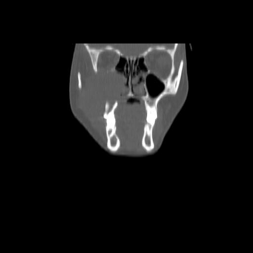 Carcinoma of the maxillary antrum (Radiopaedia 53805-59888 Coronal bone window 37).jpg