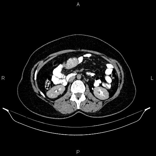 File:Carcinoma of uterine cervix (Radiopaedia 85861-101700 Axial C+ delayed 31).jpg