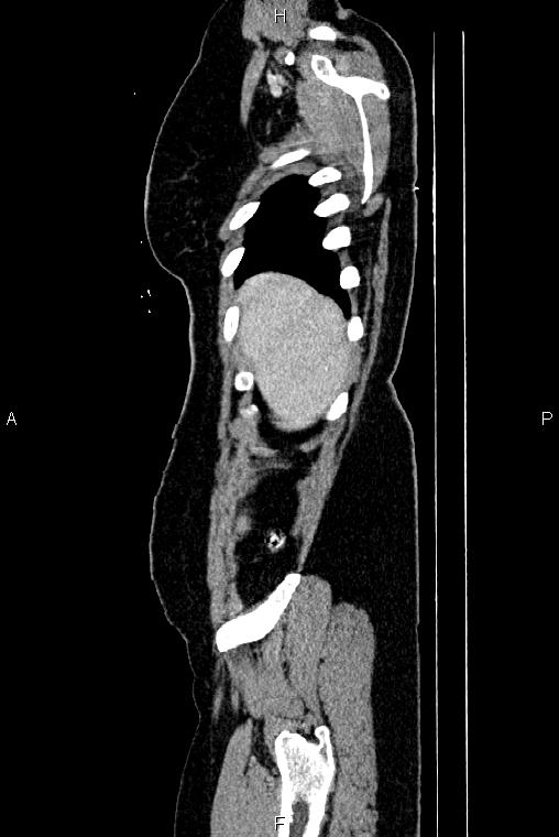 Carcinoma of uterine cervix (Radiopaedia 85861-101700 D 3).jpg