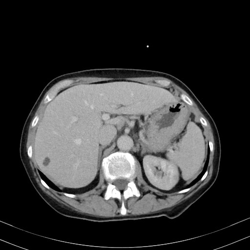 Carcinosarcoma (Radiopaedia 70401-80503 A 16).jpg