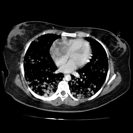 File:Cardiac angiosarcoma (Radiopaedia 66010-75181 B 111).jpg