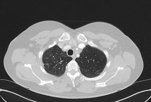 File:Cardiac sarcoidosis (Radiopaedia 74548-85534 Axial lung window 14).jpg