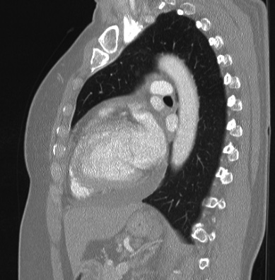 Cardiac sarcoidosis (Radiopaedia 74548-85534 Sagittal lung window 36).jpg