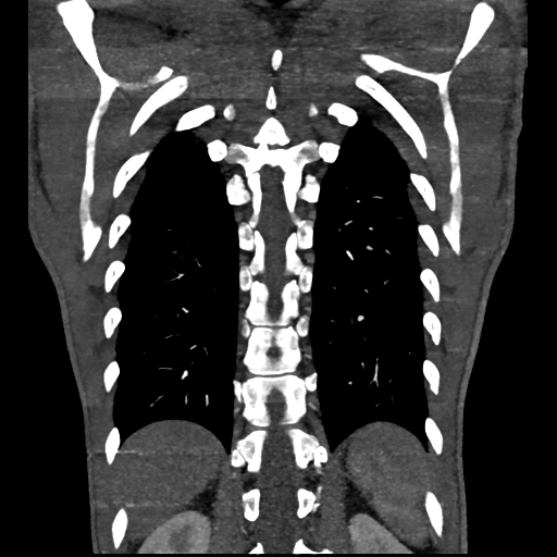 Cardiac tumor - undifferentiated pleomorphic sarcoma (Radiopaedia 45844-50134 Coronal non-contrast 60).png