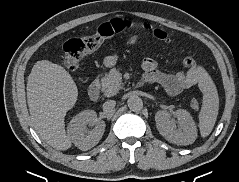 Cardiogenic pulmonary edema (Radiopaedia 68180-77678 Axial non-contrast 72).jpg