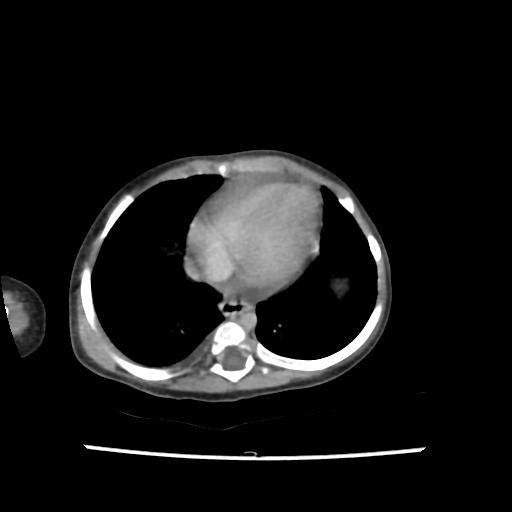 Caroli disease with autosomal recessive polycystic kidney disease (ARPKD) (Radiopaedia 89651-106703 B 7).jpg