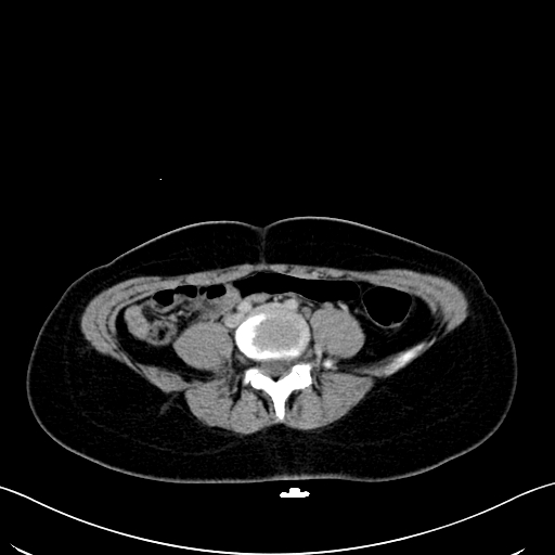 Caroli disease with medullary sponge kidney (Radiopaedia 82622-96804 C 48).jpg