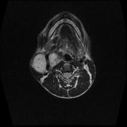 File:Carotid body tumor (Radiopaedia 30208-30823 Axial T2 8).jpg